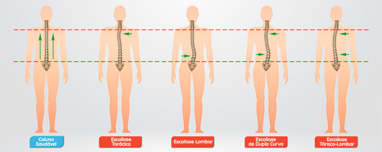 Escoliose: tipos de curvaturas