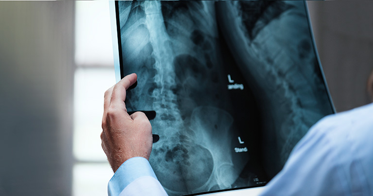 Escoliose em adultos e crianças